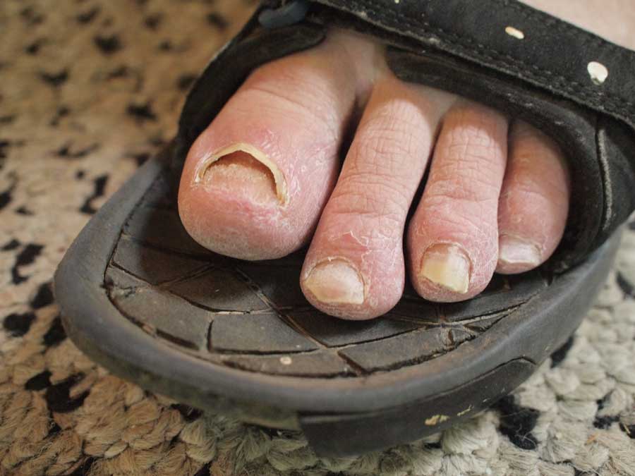 Toe Trouble